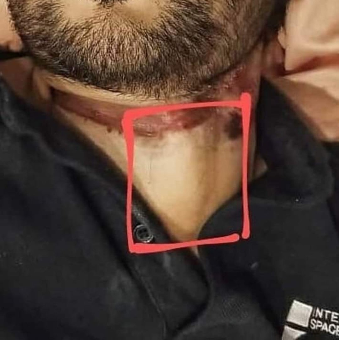 sumidas198's tweet photo. 🔸Legs broken
🔸hands stretch
🔸partial eyes open 
🔸stun gun &amp; needle marks on neck
🔸'O' shaped ligature 
🔸bruises on face
🔸deep cut mark on abdomen

How can all these happen due to a Suicide ⁉️
 @ips_nupurprasad @PMOIndia
CBI Who Killed Sushant
 https://t.co/dGQAwc2pEK