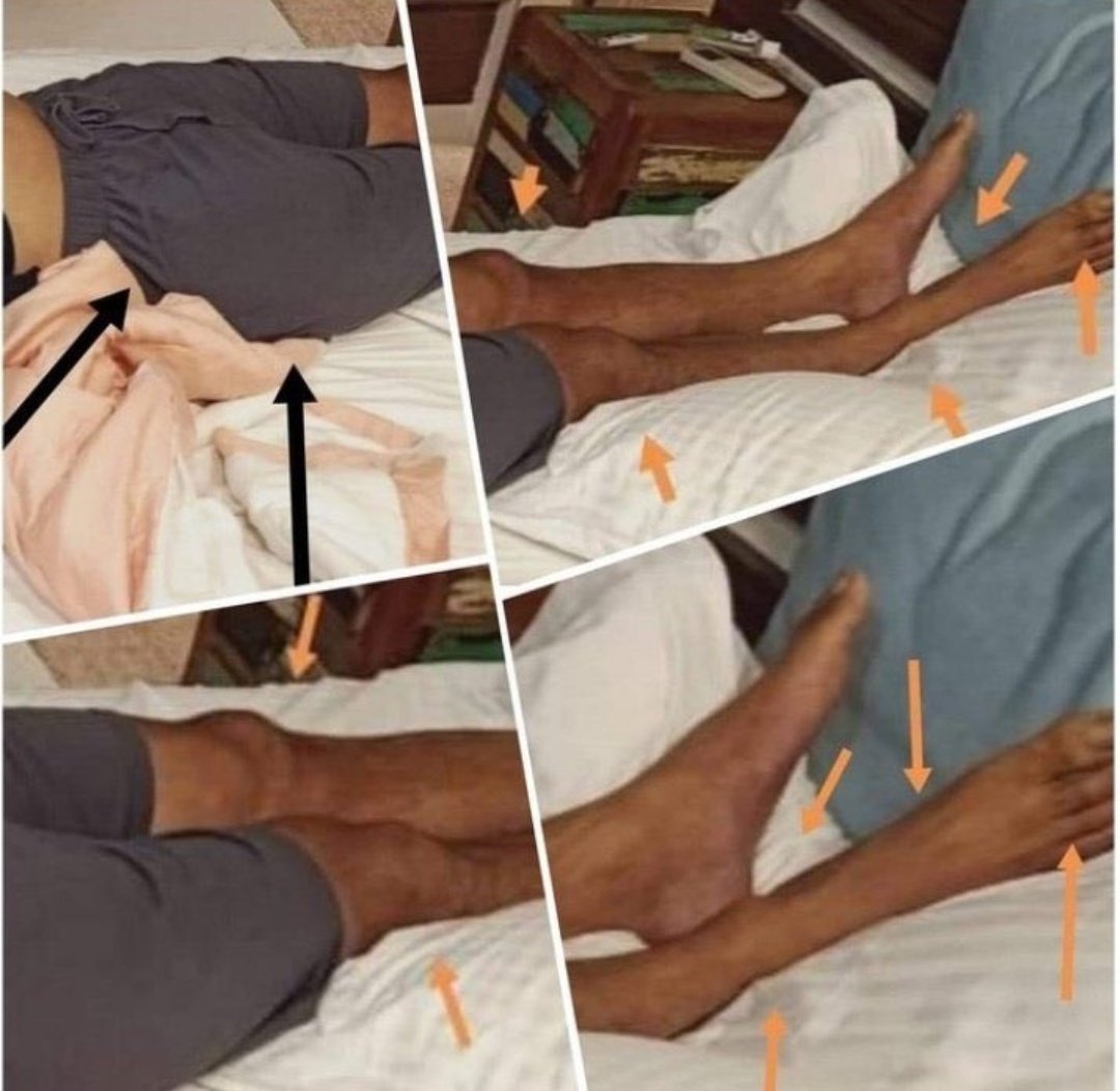 sumidas198's tweet photo. 🔸Legs broken
🔸hands stretch
🔸partial eyes open 
🔸stun gun &amp; needle marks on neck
🔸'O' shaped ligature 
🔸bruises on face
🔸deep cut mark on abdomen

How can all these happen due to a Suicide ⁉️
 @ips_nupurprasad @PMOIndia
CBI Who Killed Sushant
 https://t.co/dGQAwc2pEK