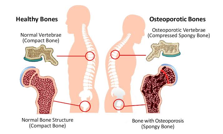 Alimentos osteoporosis