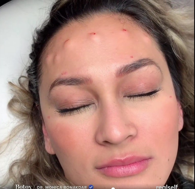 Bulging is an interesting and weird occurrence- yet not surprising after manipulating such sensitive parts of the face (basically anywhere in the face)In the pictures attached, there is a noticeable similarity (almost identical) to the lumps on Heard& #39;s foread & the patient.
