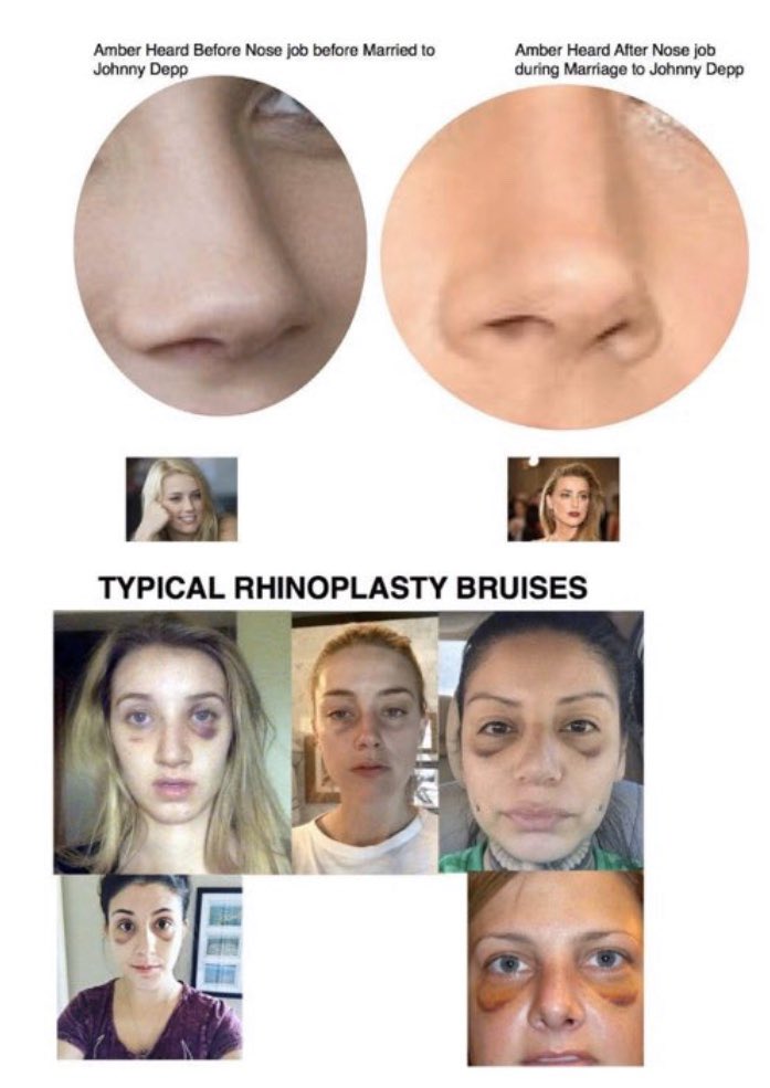 Did you know... Rhinoplasty bruises can be undetectable within 12 days? Fun fact*