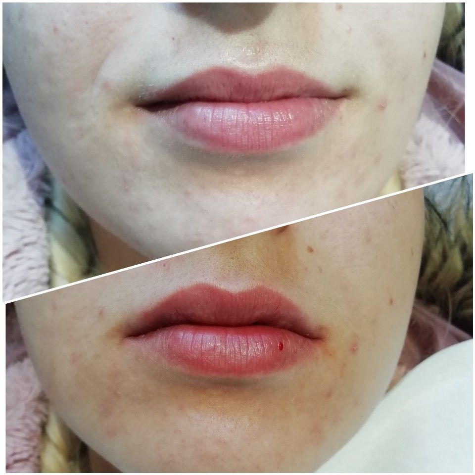 Let's talk about lip injections.Lip fillers, lip augmentations, lip injections... usually all do one thing: make your lips more pronounced. After the procedure, there can be bleeding from the injection site. If you are prone to picking your lips* well then bleeding is expected.