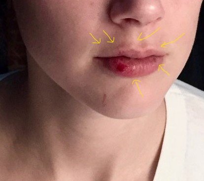 Let's talk about lip injections.Lip fillers, lip augmentations, lip injections... usually all do one thing: make your lips more pronounced. After the procedure, there can be bleeding from the injection site. If you are prone to picking your lips* well then bleeding is expected.