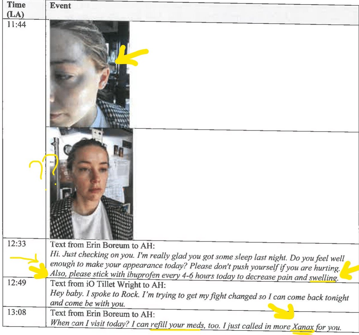 The documents in this case have presented evidence that is beyond deniable.Besides lip picking, Amber is known to suffer from anxiety & excessive alcohol consumption. There are side effects amongst both.*Note the PRONOUNCED cheekbones*Note procedures fade after 6-12 months