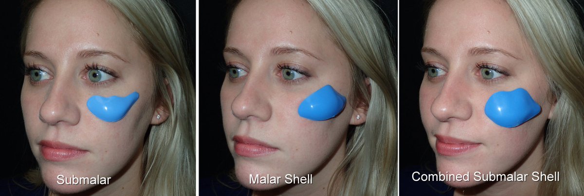 "Cheek implants are a relatively simple procedure that takes about 15 minutes per side and can be performed under local anesthesia or IV sedation. The surgery causes moderate swelling and the recovery is usually about a week."Malar Shell implant augments the actual cheekbone.