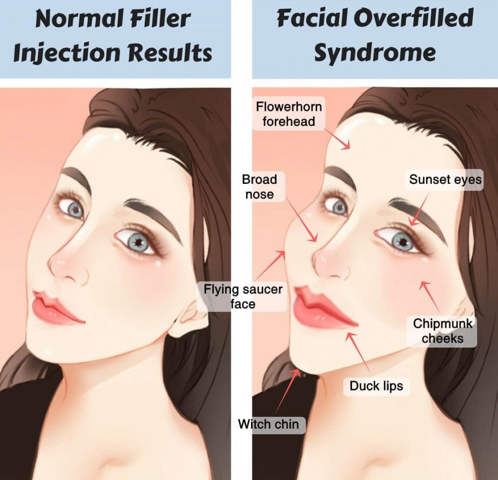 Very important to watchThe truth about derma fillers and how they may not fade over time like we're led to believe, sometimes they come back 6-7 (maybe more) years laterLink: Proof attached.