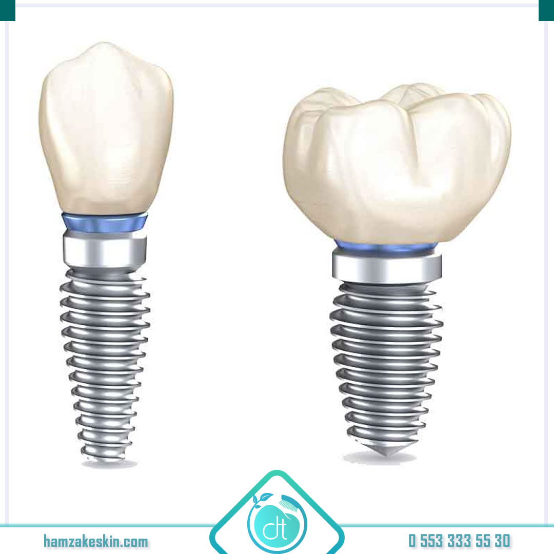 💫 Dti implant sistemleri kliniğimize gelen hastalarımızca da oldukça fazla tercih ediliyor. 
💫 Tecrübelerimiz ile Dti implant sistemlerinin sorun yaratmadan kullanılabilen ürünlerden birisi olduğunu rahatlıkla ifade edebiliriz.
💫 DTİ İmplant 👉 bit.ly/39CTdqB