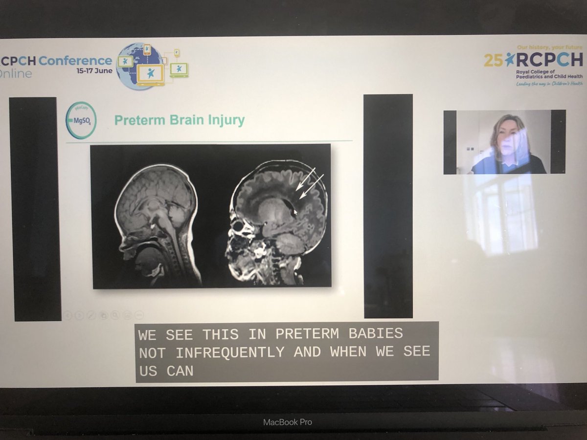 PreCEPT study presented by ⁦<a href="/KarenLuyt/">Karen Luyt💙</a>⁩ in the ⁦<a href="/BAPM_Official/">BAPM</a>⁩ ⁦<a href="/NeonatalSociety/">The Neonatal Society</a>⁩ section of the #RCPCH Spring meeting