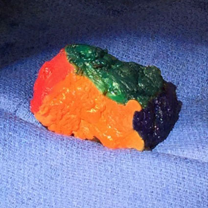 VectorSurgical's tweet image. #MarginMarker is a sterile ink kit that accurately delineates the entire margins of excised tissue. Visit VectorSurgical.com to request a sample.