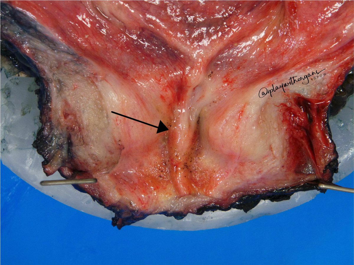 iplaywithorgans's tweet photo. Step right up and test your GU anatomy knowledge. Do you know what this bump is called in the prostrate? Check out the poll in the comments and vote. Answer to be revealed on Friday.

#GPOW #beardedPA #UofCPath https://t.co/yDi22o4rGe