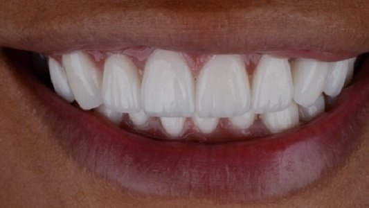 #Veneers are a type of prosthesis that are placed over the surfaces of #teeth to improve their integrity and appearance. #Prosthetics #Dentistry....Read more@ bit.ly/3vBypbq