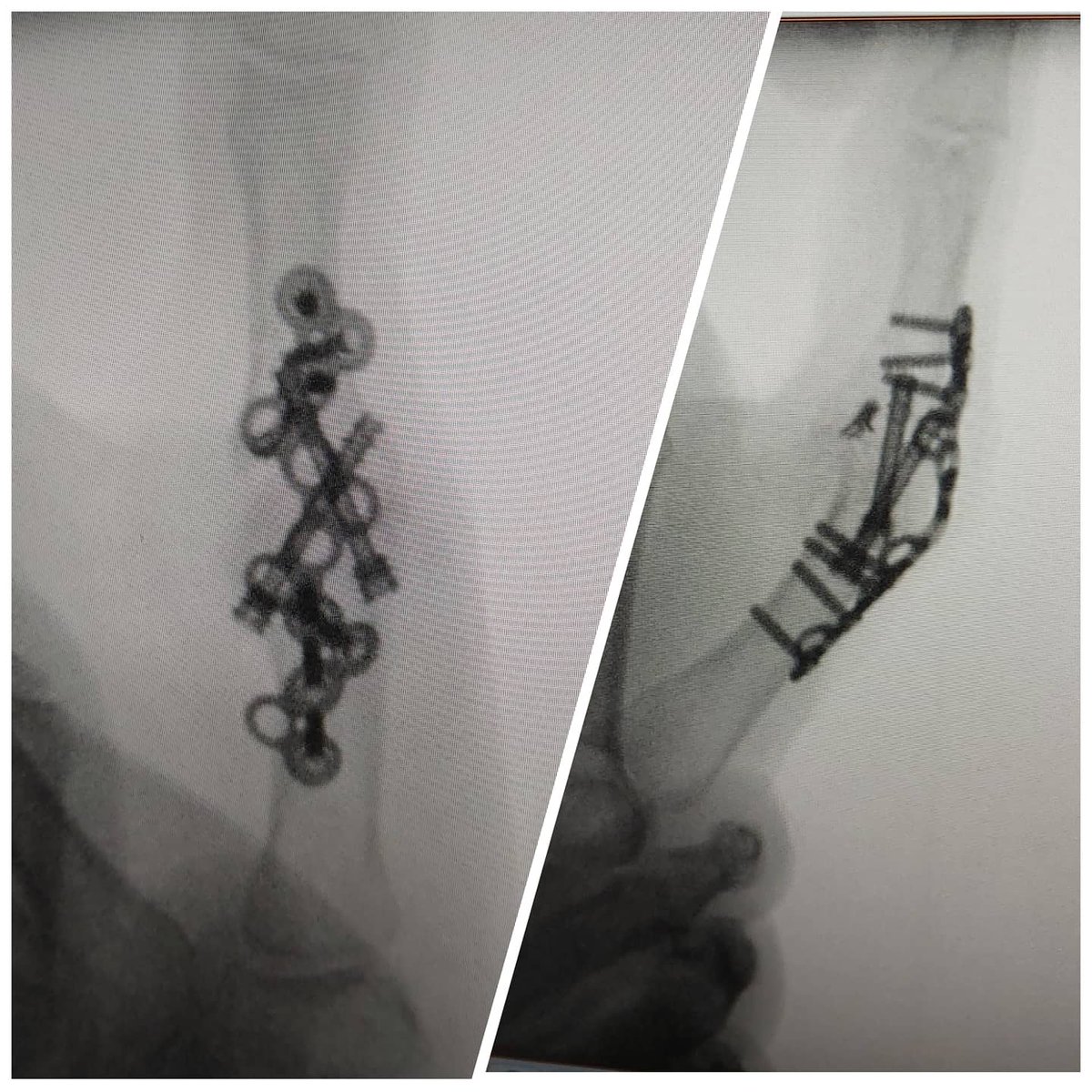 drpajares's tweet photo. Disfruto...si estoy con l@s mejores
 Equipo quirúrgico inigualable @ClinicaNavarra
Artrodesis de pulgar con placa @Surgival
Artrodesis de muñeca @Arthrex
Acortamiento de cúbito 
@Medartis_Global https://t.co/newZsTukAh