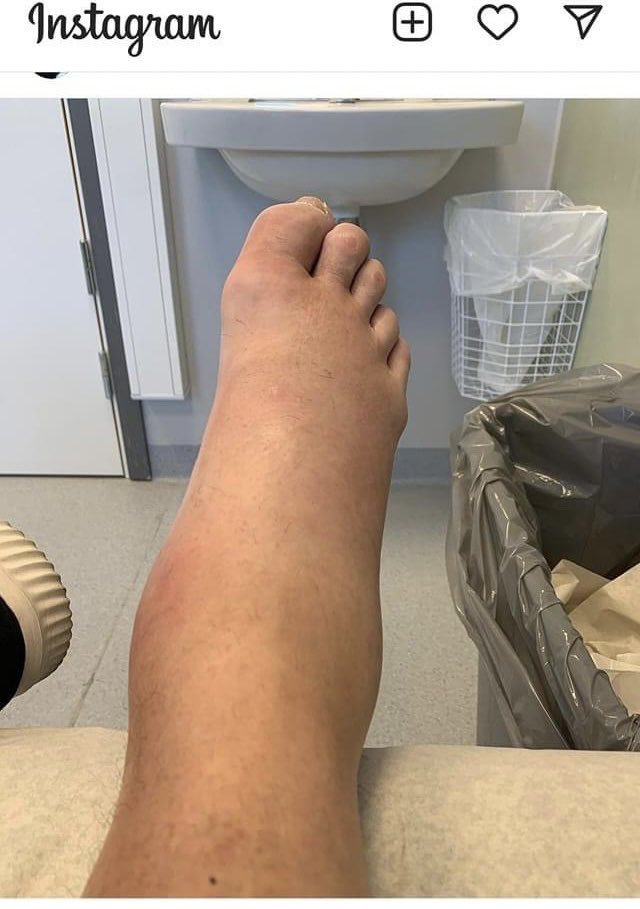 Glenn Hyséns padel-skadade fot ser ut som smörknivarna jag gjorde i mellanstadiet