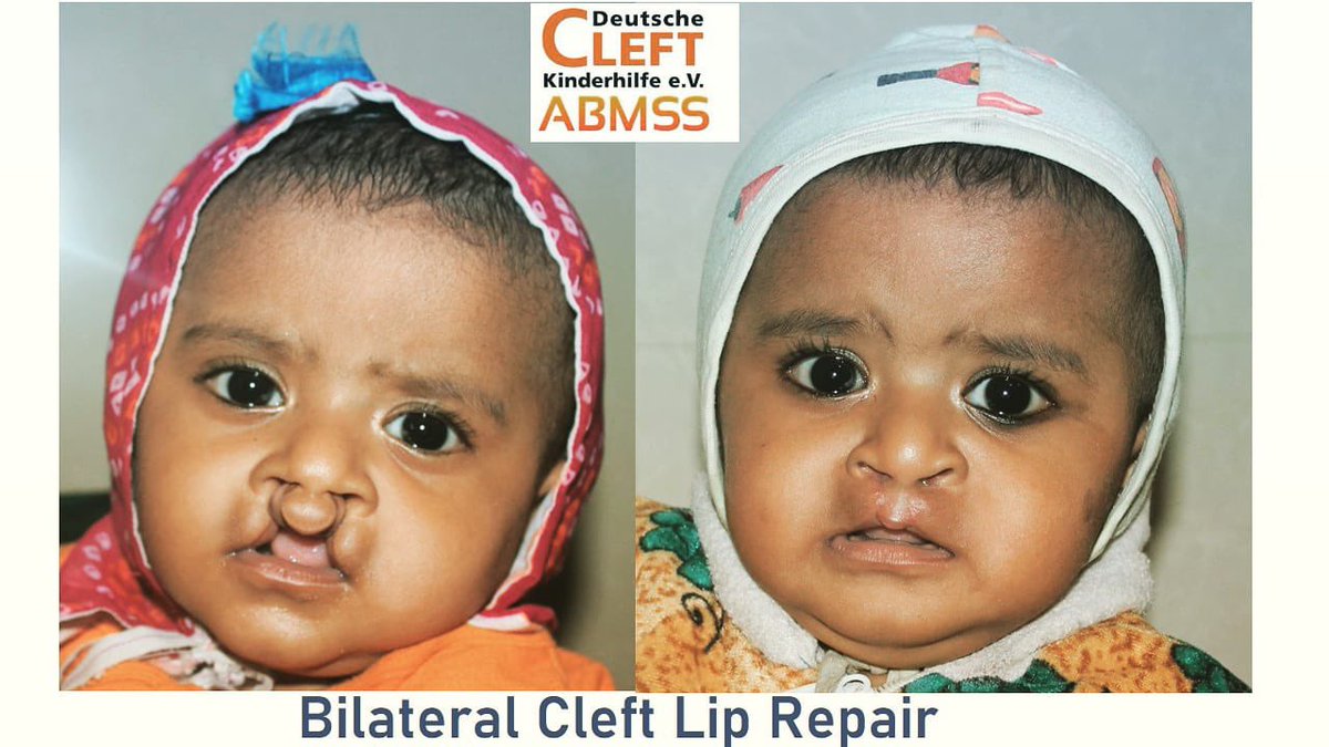 dr_sangitaa's tweet photo. If you come across any child with cleft lip disorder. Pls share the details. We will support them for free surgery in Maharashtra. Kindly spread the word 🙏🏻Let’s bring the smile back 😊 #cleft #cleftsurgery #freesurgery #heyhelp #heyfoundation #cleft https://t.co/ndvqwBCGQv
