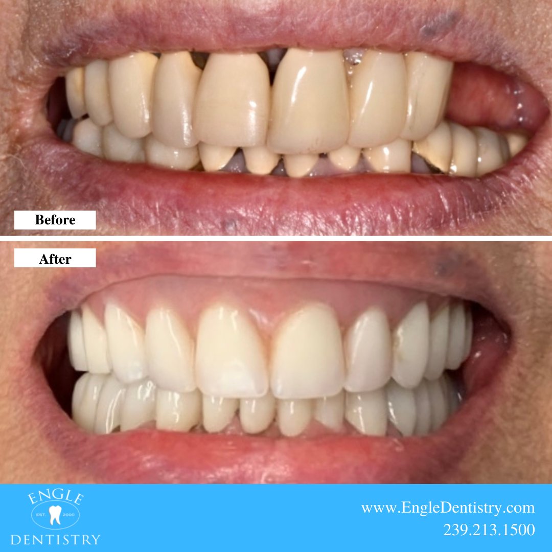 EngleDentistry's tweet photo. Smile design makeovers are our favorite and you can see why here. Our patient desperately wanted to have functional teeth so that she could eat her favorite food...PIZZA! We were so happy to help that we threw her a pizza party at the end of her appointment. #beautifulsmiles https://t.co/NoEonC9zeI