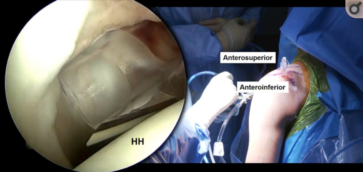MillettMD's tweet photo. The purpose of this study is to describe the preferred surgical technique with a #rotatorcuffโsparing approach for arthroscopic #SLAPrepair with all-suture anchors. https://t.co/XC7GC4l1Ze #medtwitter https://t.co/hcrlWlJ1qG