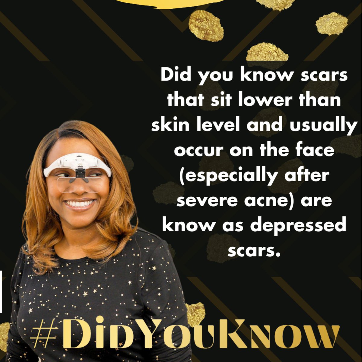WorthyInkStudio's tweet photo. Did you know scars that sit lower than skin level and usually occur on the face (especially after severe acne) are know as depressed scars. https://t.co/rRazkCDHK4