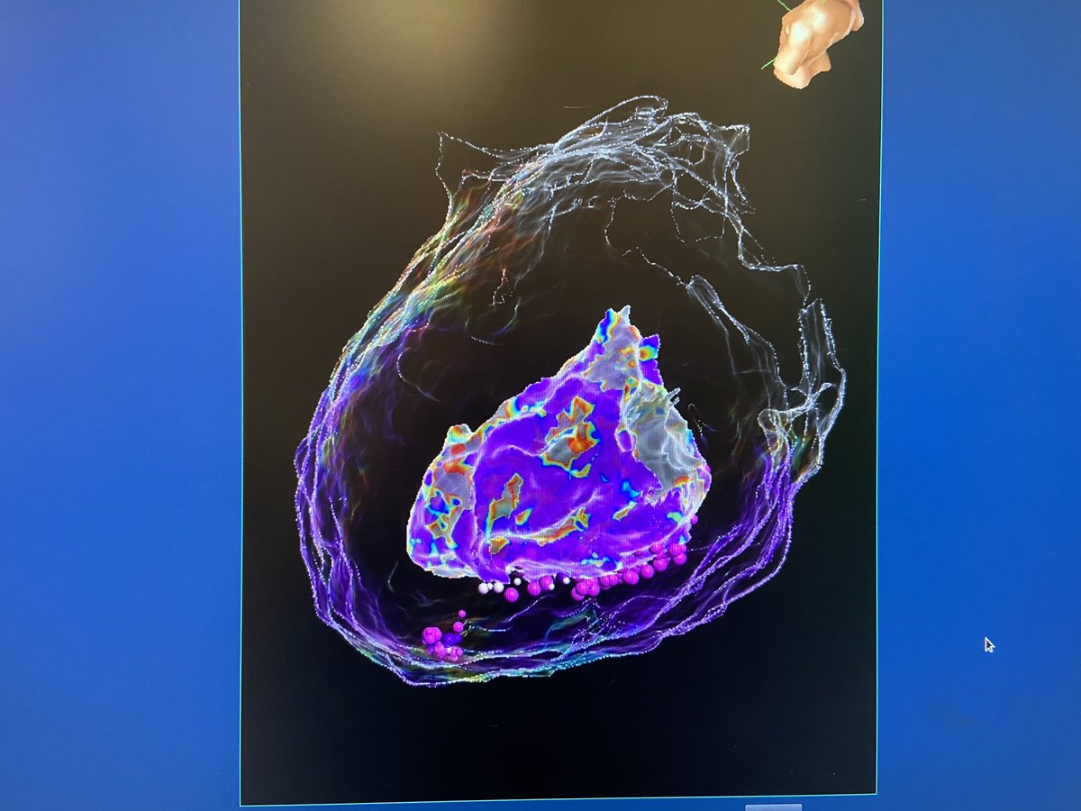 texasEPkait's tweet photo. Impressive late potentials today on LivewireHD during this non-ischemic VT! Similar signals seen at the corresponding epicardial location. Mapped by @PraveenRao_EP at @bswhealth_DFW #hdgrid #ablatevt @AbbottCardio https://t.co/xZpOgdTpJ7
