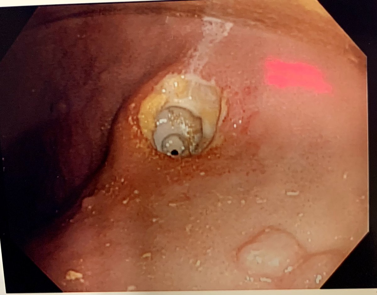 Buried bumper !
Interventional Endsocopy Called by trauma and Gen Gi - poor surgical candidate.  No free air on cT scan.  Tenderness with palpating.  No frank peritoneal signs.  Tube flushes. What to do? <a href="/ASGEendoscopy/">ASGE GI Endoscopy</a> <a href="/AmerGastroAssn/">American Gastroenterological Association (AGA)</a> <a href="/AmCollegeGastro/">ACG</a> <a href="/stevenbollipo/">Steven Bollipo</a> <a href="/drkeithsiau/">Keith Siau</a>