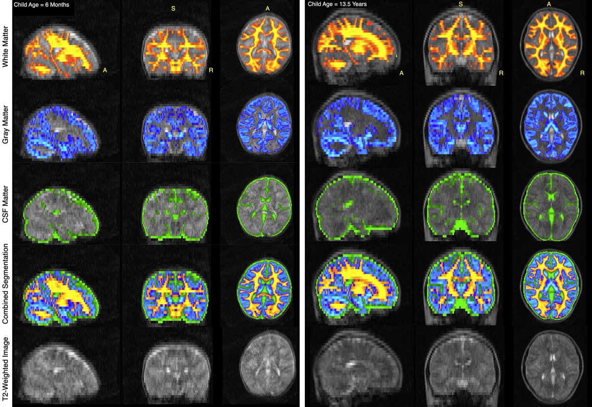 Advanced Baby Imaging Lab (@babyimaging) on Twitter photo Happy to share out some images from our forthcoming #neuroimage paper. Low Field pediatric imaging and brain growth measures using the <a href="/Hyperfine/">Swoop® Portable MR Imaging® System–Hyperfine, Inc</a> system. Happy to share out some images from our forthcoming #neuroimage paper. Low Field pediatric imaging and brain growth measures using the <a href="/Hyperfine/">Swoop® Portable MR Imaging® System–Hyperfine, Inc</a> system.