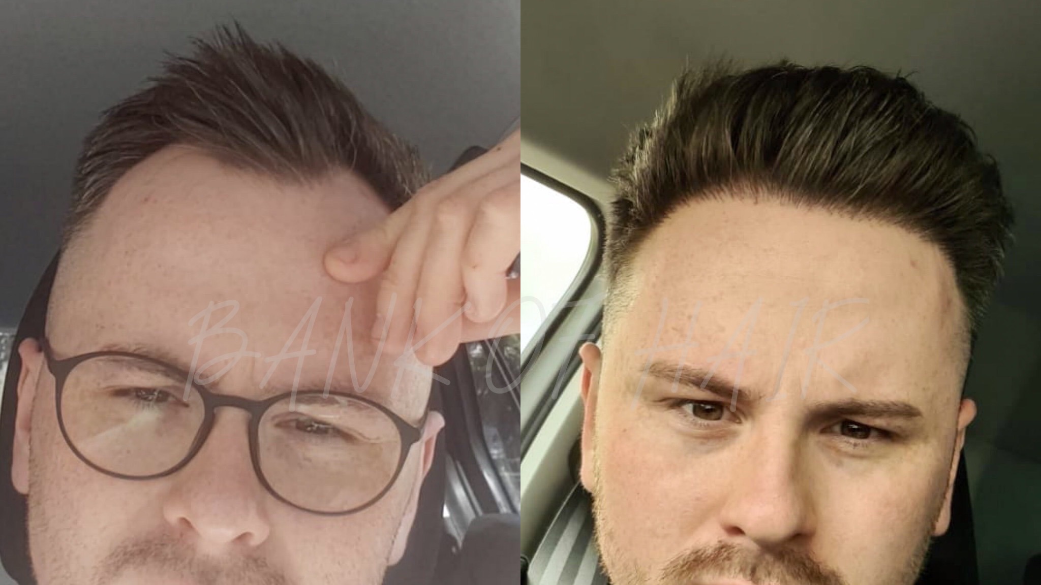 Erfahrungen haartransplantation Haartransplantation Türkei