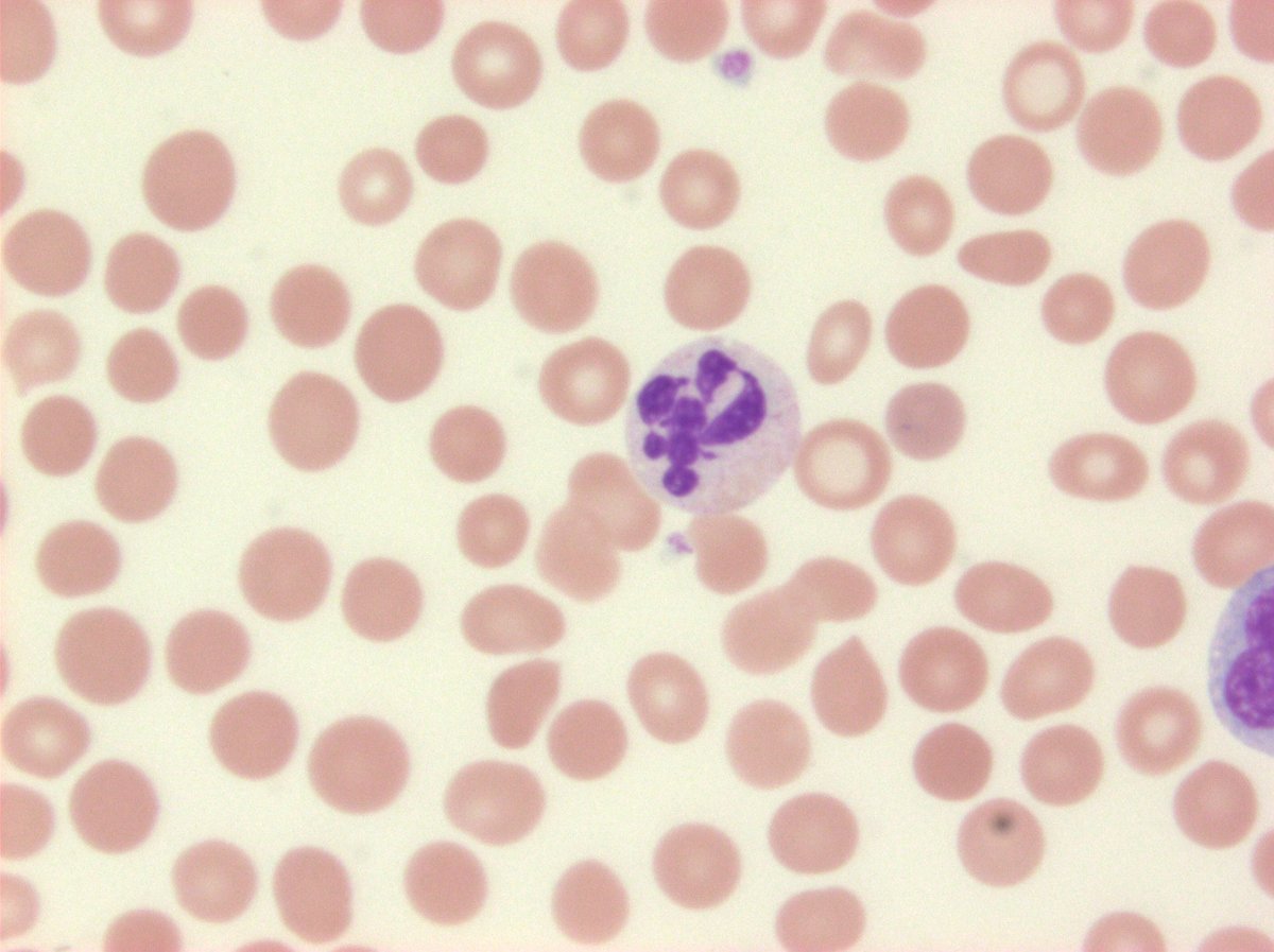 Funny looking neutrophil from CMML. Kinda like Prince's symbol combined with a scorpion?