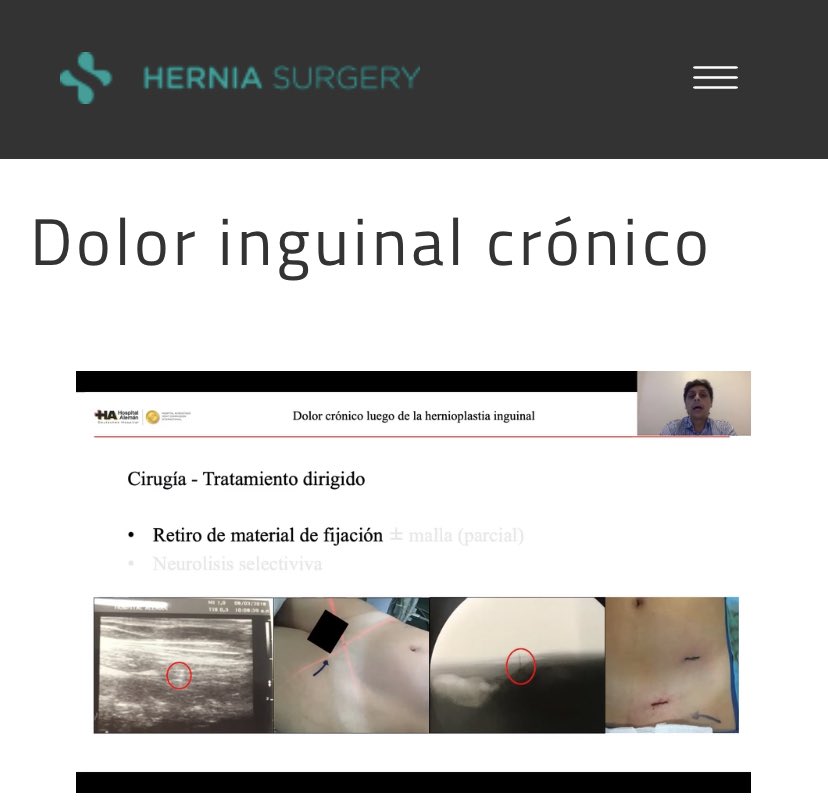 Muy agradecido por la invitación!Charla sobre dolor crónico post-hernioplastia inguinal. <a href="/drporrero/">Jose Luis Porrero</a> #SoMe4Surgery <a href="/AMHernia/">Asociación Mexicana de Hernia AMH</a> @herniacompleja <a href="/eurohernias/">European Hernia Society</a> <a href="/AecPared/">Seccion Pared AEC</a> 
herniasurgery.es