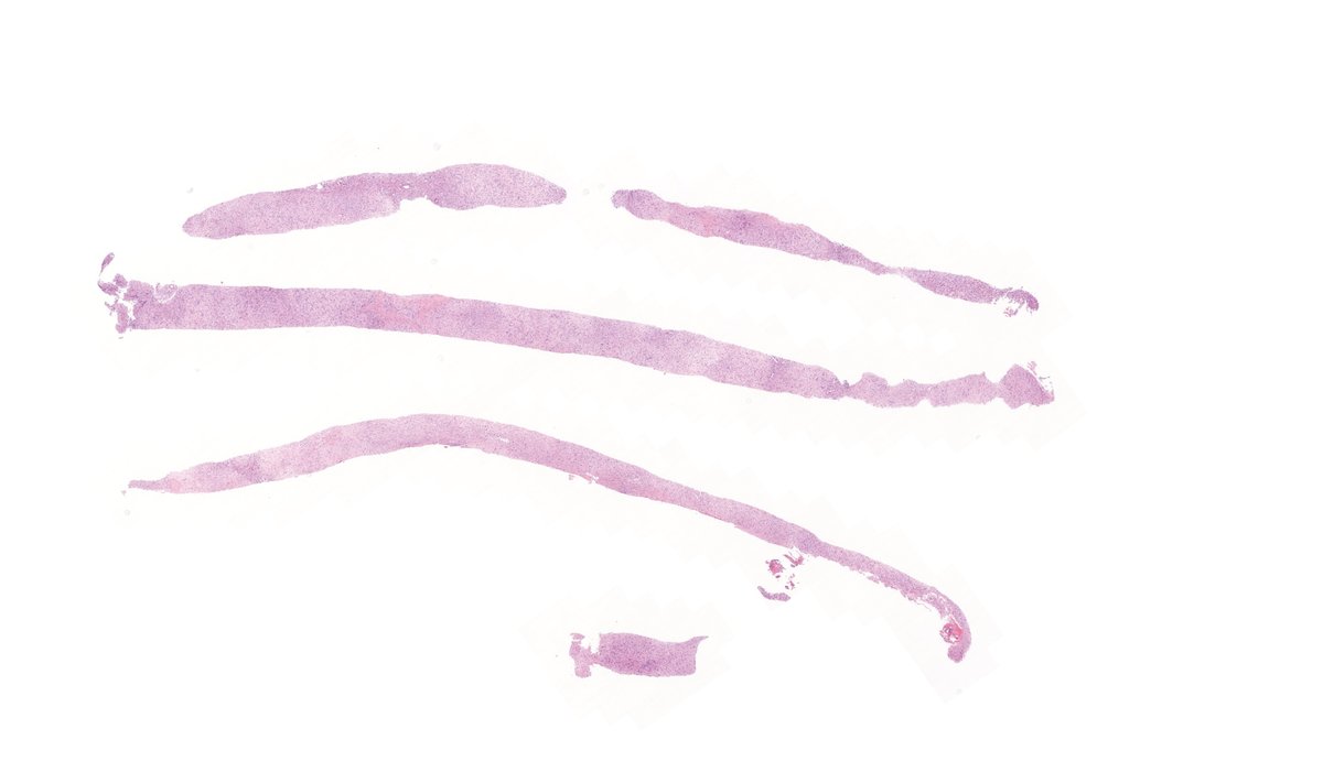 TristanRutland7's tweet photo. Liver, adult
#GIpath #pathtwitter https://t.co/yJTgZ51Tvm
