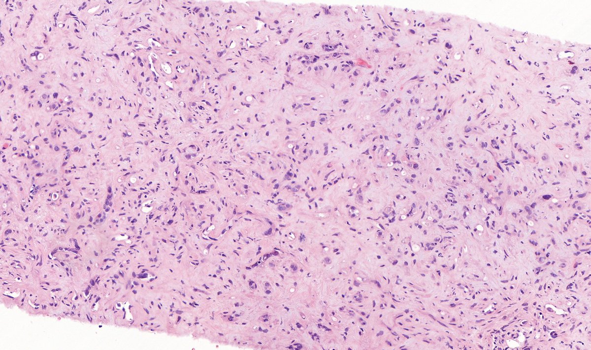 TristanRutland7's tweet photo. Liver, adult
#GIpath #pathtwitter https://t.co/yJTgZ51Tvm
