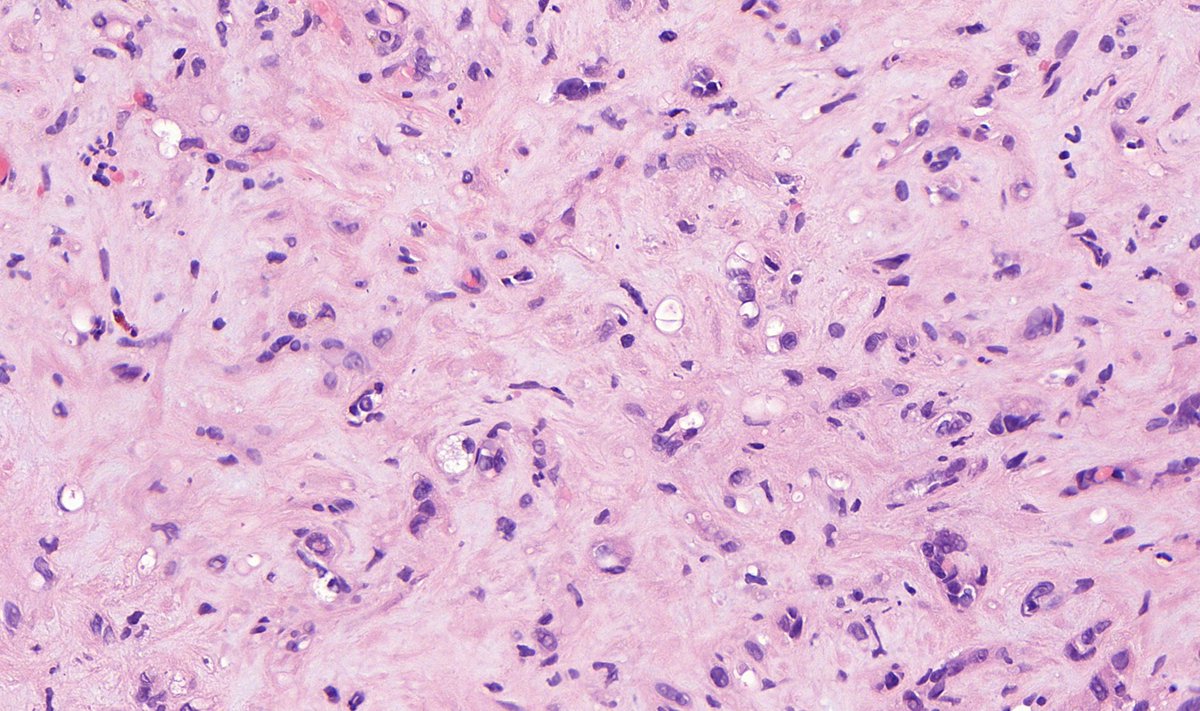 TristanRutland7's tweet photo. Liver, adult
#GIpath #pathtwitter https://t.co/yJTgZ51Tvm