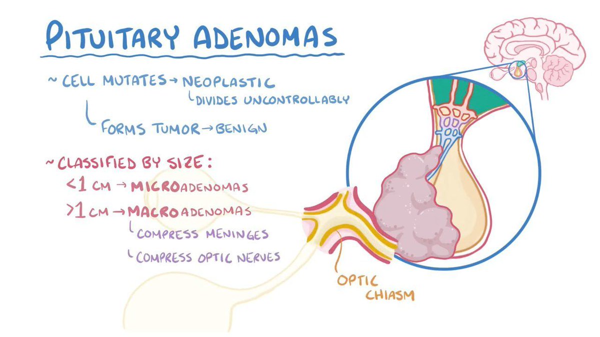 endocrinology20's tweet photo. Submission Open for "Pituitary apoplexy"
Email: endocrinology@maplejournal.com
#endocrinology #Cushingsyndrome #coronaviruspandemic #covid19 #fibers #tumor #pituitary  #submissions #socialmediamarketing 
@DrVinodEndo @JulieABrake @MaliniGuptaMD @alemalaquias72 https://t.co/V1uth8tqRX