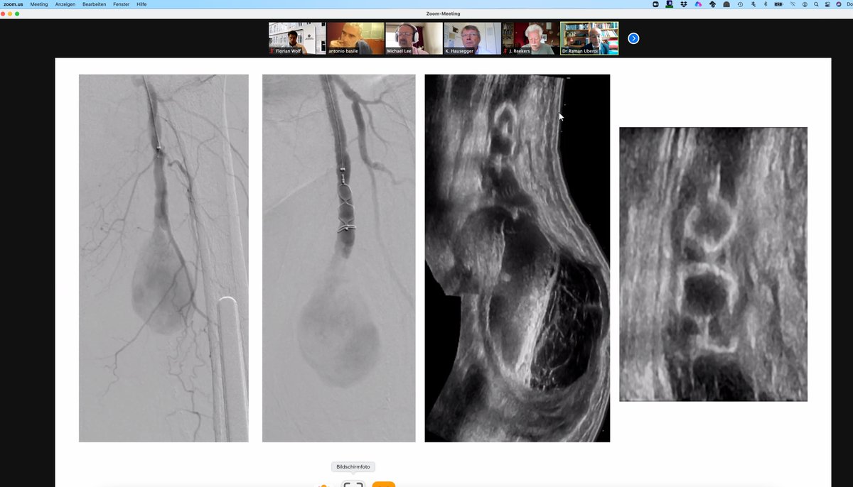 Florian Wolf (@docflo) on Twitter photo Join us at #ET2021 - live now at et2021.cirse.org Channel 2 #IR #IRAD #CIRSE2021 Join us at #ET2021 - live now at et2021.cirse.org Channel 2 #IR #IRAD #CIRSE2021