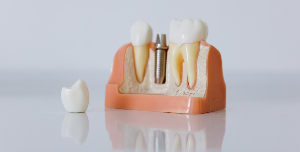 CetC_Ortho's tweet photo. Le Cobalt remplacé par le Titane pour les prothèses dentaires 👉
https://t.co/tDJJWLN202 #innovation #santé #dentaire https://t.co/1TAqNFa8se