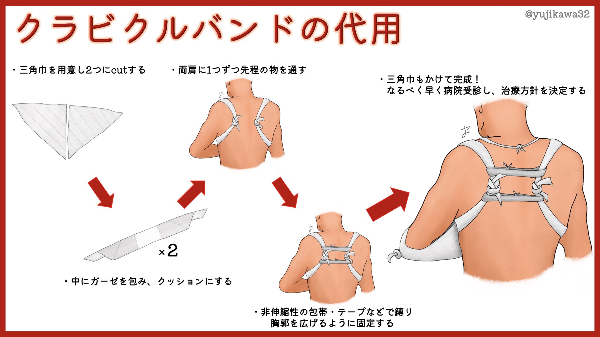 ユジカワ 整形dr イラストレーター スキー場のsnow Aid接骨院に見学に行った際 角野先生 Kakuno Snowaid から教わったテクニック 病院だと鎖骨骨折にはクラビクルバンドが使えるが なかなかスポーツ現場にまでは持ち出していない 病院受診までの除