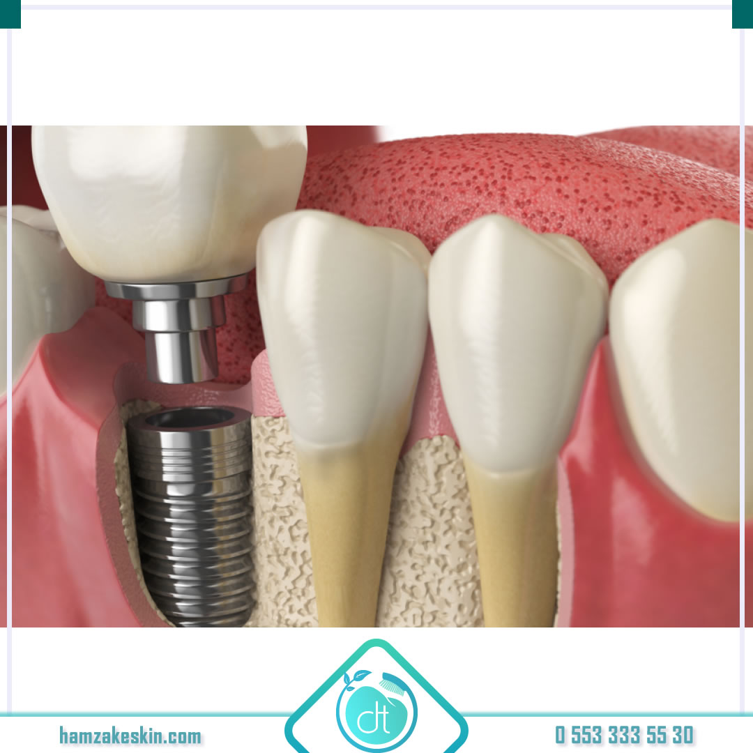 🎗Keskin Diş Kliniği olarak bizler sektörün en kaliteli markalarıyla iş birliği yapıp marka seçimini siz değerli hastalarımıza bırakıyoruz. 
🎗Mis İmplant 👉 bit.ly/3s5gkAq 

#mis #implant #implantmarkası #misimplantparçası #ağızsağlığı
