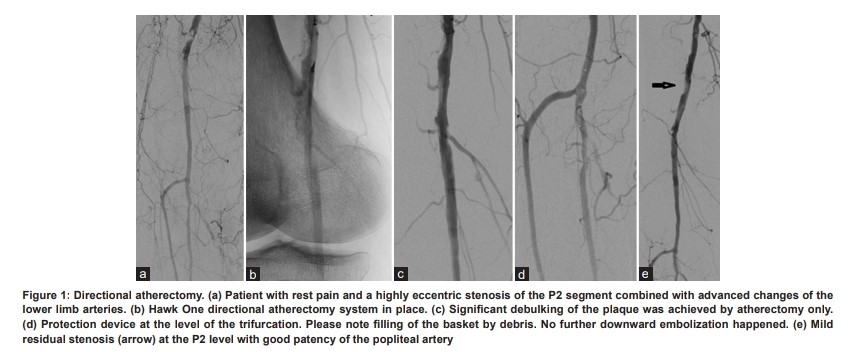 #AJIR How to Deal with Infrainguinal Arterial Calcifications: Atherectomy and Lithoplasty Devices @pairsmedia @PairsWeb Abstract: thieme-connect.com/products/ejour… HTML: thieme-connect.com/products/ejour… PDF: thieme-connect.com/products/ejour…