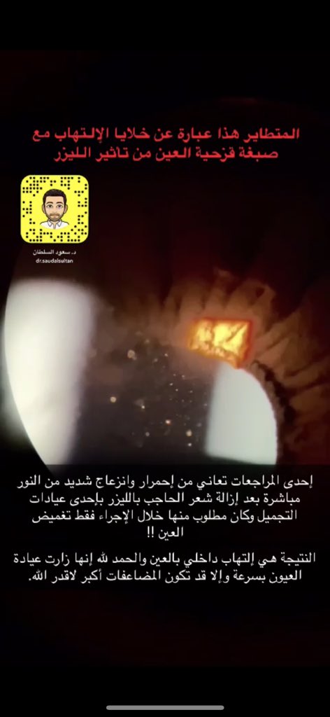 drsaudalsultan's tweet photo. الحمد لله تم نشر في إحدى المجلات العلمية هذه الحالة للتوعية من خطورة استخدام ليزر إزالة الشعر بالوجه دون وضع نظارة الحماية@HashKSA @co_aw1 https://t.co/oG2TRLtRn1