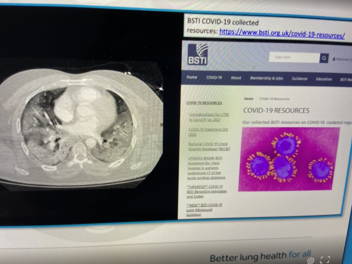 Resource available on ⁦<a href="/BSTImaging/">BSTI</a>⁩ for lung parenchymal uss imaging #BTSSummer2021 🫁