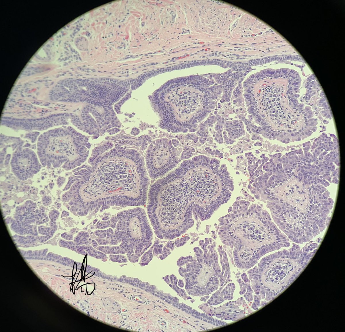 Fresh out of the oven! This is for those eager to learn residents. #PathTwitter #pathresidents #dermtwitter #dermresident #dermpath  If you have not made this diagnosis before, now it is time to Recognize it. What a cutie! Syringocystadenoma papilliferum ( SCAP). It IS from scalp