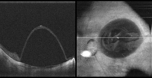 ARVOtvst's tweet photo. New and free to read: "Microscope-Integrated #OCT -Guided Volumetric Measurements of Subretinal #Blebs Created by a Suprachoroidal Approach.β
Full article: https://t.co/X2XaeIzXGI @DukeMedSchool @DukeEngineering #MIOCT #AMD #GeneTherapy #drugdelivery #OpenAccess #Ophthalmology https://t.co/HE4ess5g7d