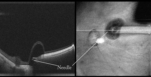 ARVOtvst's tweet photo. New and free to read: "Microscope-Integrated #OCT -Guided Volumetric Measurements of Subretinal #Blebs Created by a Suprachoroidal Approach.β
Full article: https://t.co/X2XaeIzXGI @DukeMedSchool @DukeEngineering #MIOCT #AMD #GeneTherapy #drugdelivery #OpenAccess #Ophthalmology https://t.co/HE4ess5g7d