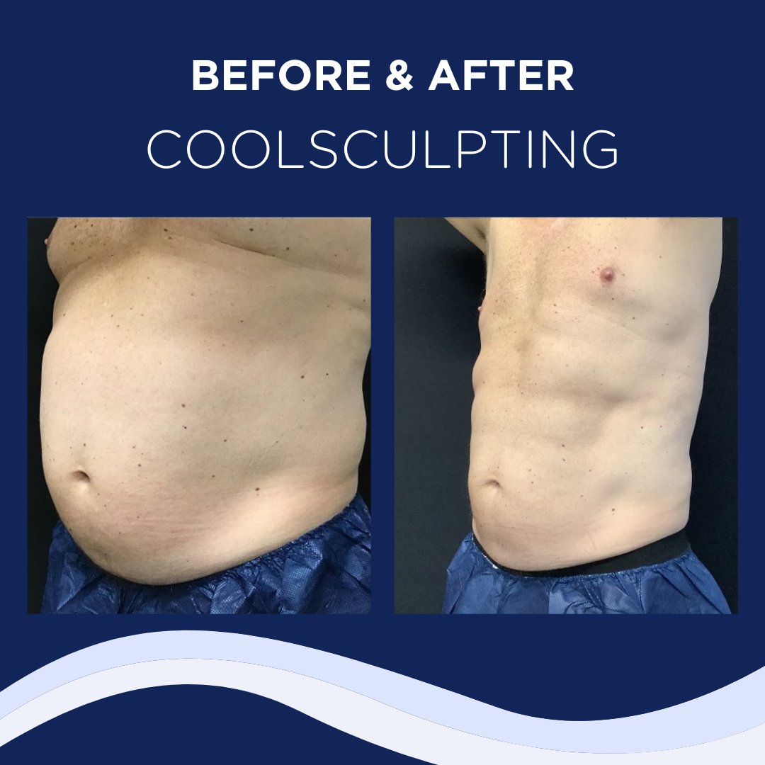 Coolsculpting Before And After