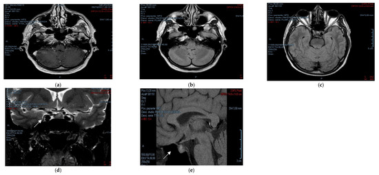 Endocrines_MDPI's tweet photo. Dr. Antonio Aversa from @UMG_Tweet and his colleague describe a rare case of #AutoimmuneHypophysitis associated with late renal disease, and without any other organ involvement.
https://t.co/Y9lTXgyaN1 https://t.co/B2iBmuFL0X