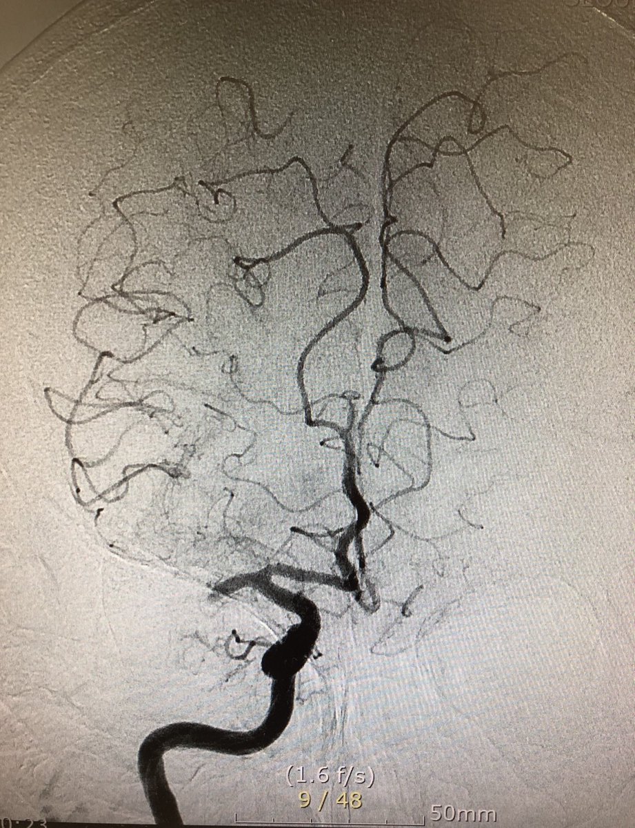 ahmedalshanbari's tweet photo. 86 F. out of the window at the time of groin puncture
Rt M1 occlusion.Thrombus was captured by #Trevo NXT.angiography showed M1 partial recanalization and occlusion of Rt distal ACA.
Marksman and #SolitaireX did the job as usual!
NIHSS from 8 >> 1
patients selection matters! https://t.co/FW8yydkQ6I