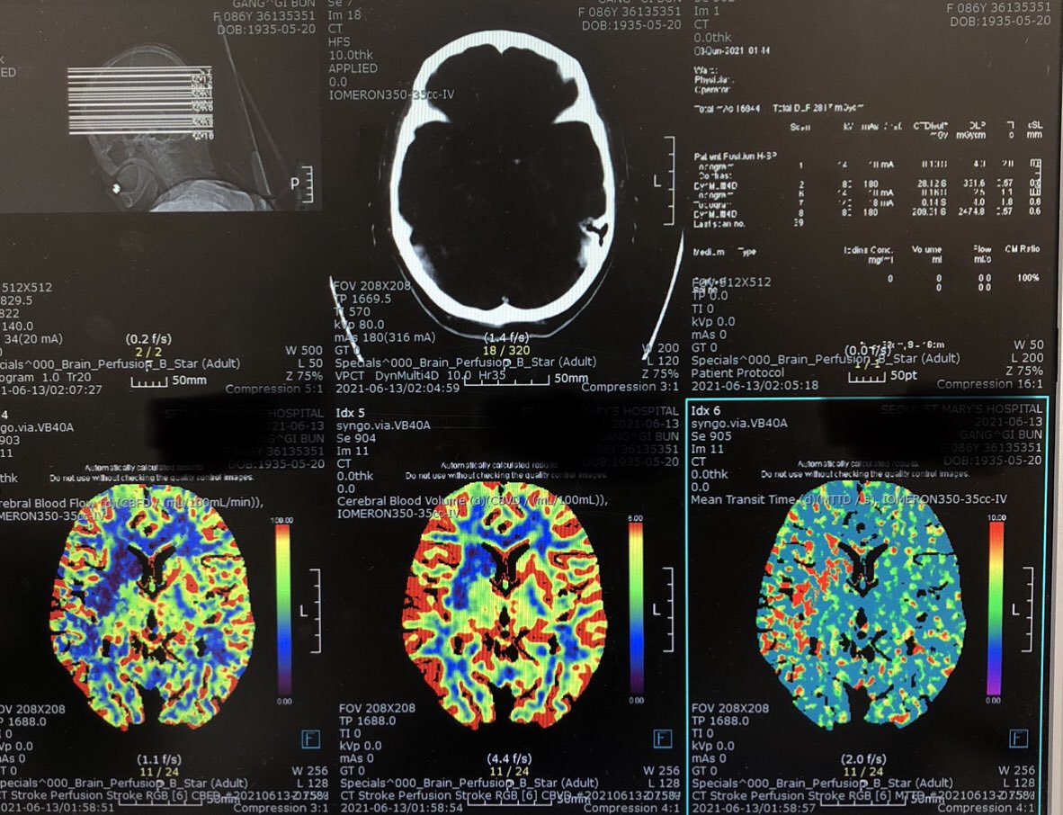 ahmedalshanbari's tweet photo. 86 F. out of the window at the time of groin puncture
Rt M1 occlusion.Thrombus was captured by #Trevo NXT.angiography showed M1 partial recanalization and occlusion of Rt distal ACA.
Marksman and #SolitaireX did the job as usual!
NIHSS from 8 >> 1
patients selection matters! https://t.co/FW8yydkQ6I