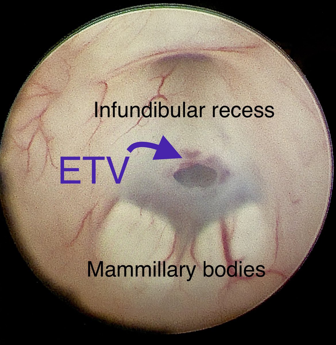 The #endoscopic third ventriculostomy (ETV). Simple, elegant, &amp; effective 

@VUMC_Neurosurg #anatomy #neurosurgery