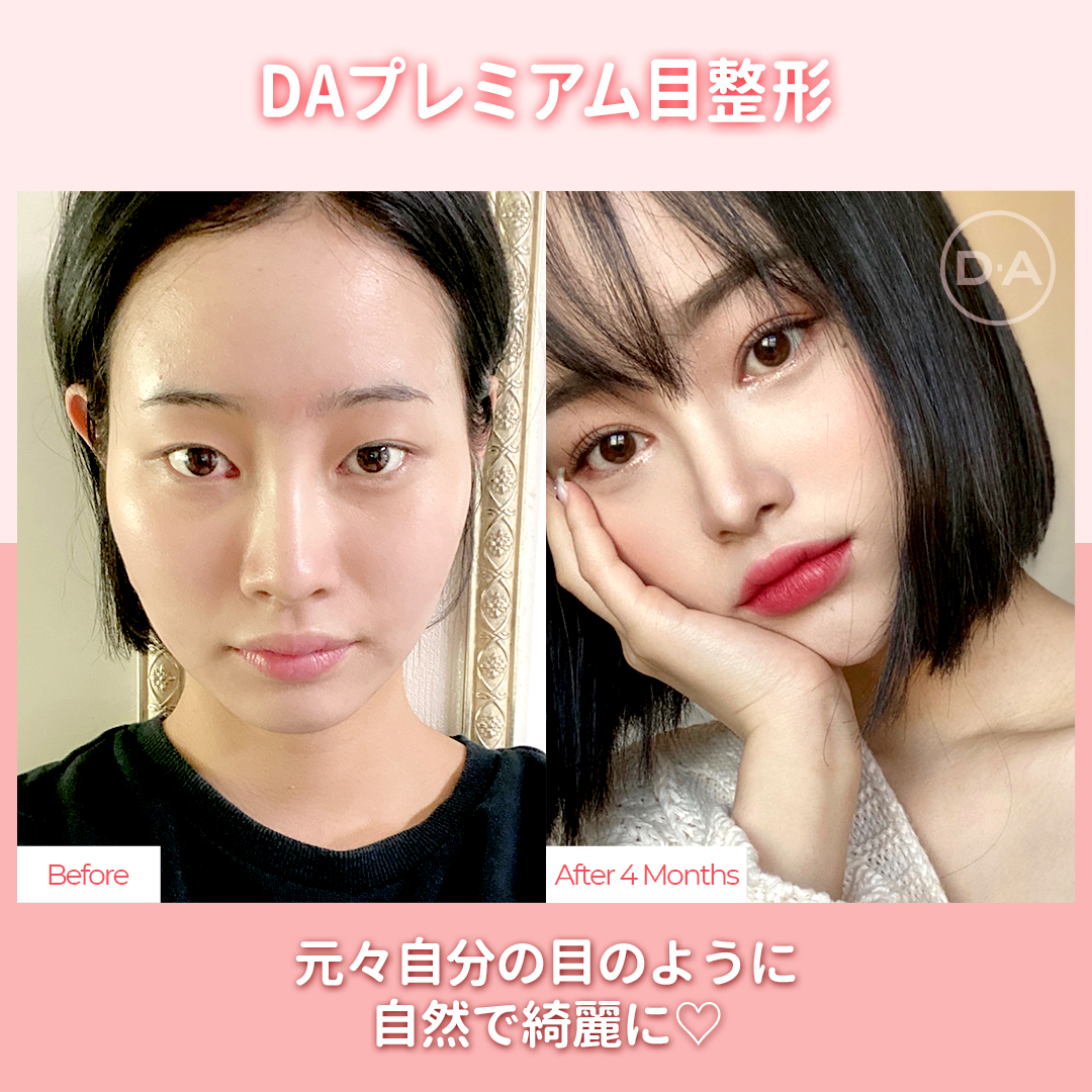 韓国整形da美容外科輪郭 鼻 目 脂肪吸引 豊胸 V Twitter 元々自分の目のように 自然に綺麗に Daプレミアム目整形なら 貴方の理想な二重ライン完成 韓国整形 韓国目整形 韓国二重手術 二重整形 韓国美容外科 二重手術 自然癒着 埋没 韓国整形da美容外科輪郭 鼻 目 脂肪吸引 豊胸 V Twitter 元々自分の目のように 自然に綺麗に Daプレミアム目整形なら 貴方の理想な二重ライン完成 韓国整形 韓国目整形 韓国二重手術 二重整形 韓国美容外科 二重手術 自然癒着 埋没