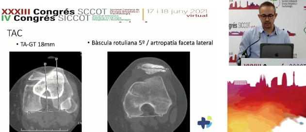 Taula Rodona de Inestabilitat Rotuliana 📌

Amb la Dra Mercè Reverté de l'Hospital Vall d'Hebrón, Dr Àngel Masferrer de l'Institut Dexeus i el Dr Sergi Gil de l'Hospital d'Igualada!

<a href="/AngelMasferrer8/">Dr. Àngel Masferrer MD PhD</a> <a href="/sergil8/">Sergi Gil</a> <a href="/Hospitaligd/">Hospital Universitari d'Igualada</a> <a href="/QS_Dexeus/">Hospital Universitari Dexeus</a> <a href="/vallhebron/">Vall d'Hebron</a> #CongrésSCCOT2021 #Amicsdelgenoll