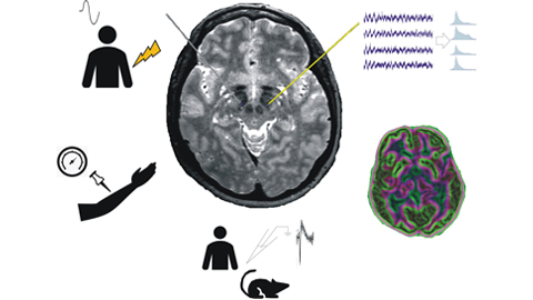 Mostofi et al. examine evidence for the involvement of the STN in pain-related networks in Parkinson's disease, and propose mechanisms by which STN stimulation could modulate pain processing and perception. bit.ly/34n9vkq