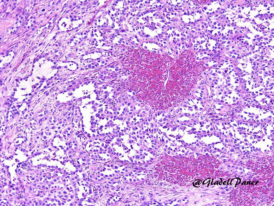 Striking example of pseudoangiosarcomatous (acantholytic) urothelial carcinoma. Pankeratin+, Gata3+, p63+, and vascular markers-. #GUPath